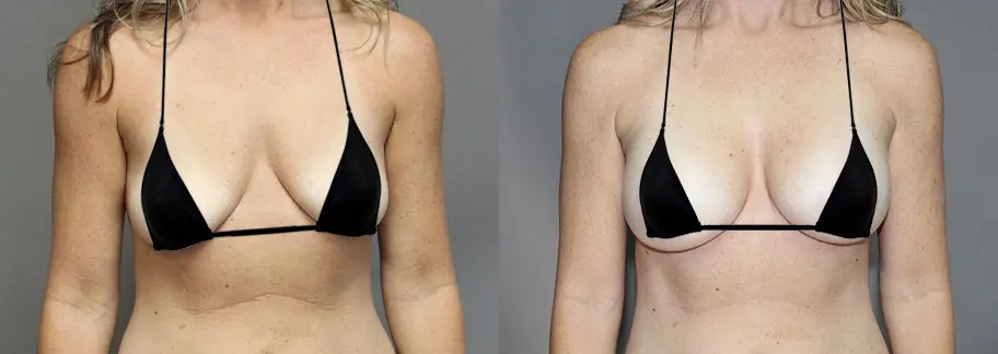 Before & After Photo