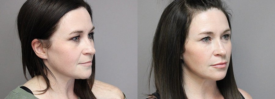 Before and After Plastic Surgery Results | CraftMD Scottsdale & Phoenix, AZ