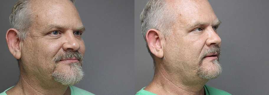 Before and After Plastic Surgery Results | CraftMD Scottsdale & Phoenix, AZ
