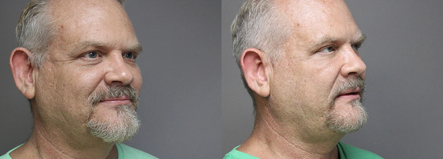 Before and After Plastic Surgery Results | CraftMD Scottsdale & Phoenix, AZ