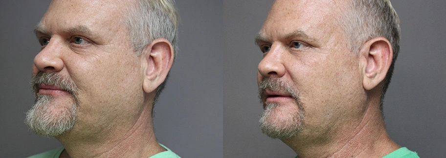 Before and After Plastic Surgery Results | CraftMD Scottsdale & Phoenix, AZ