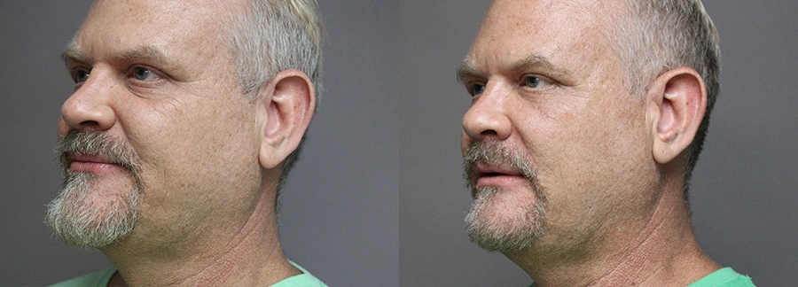 Before and After Plastic Surgery Results | CraftMD Scottsdale & Phoenix, AZ