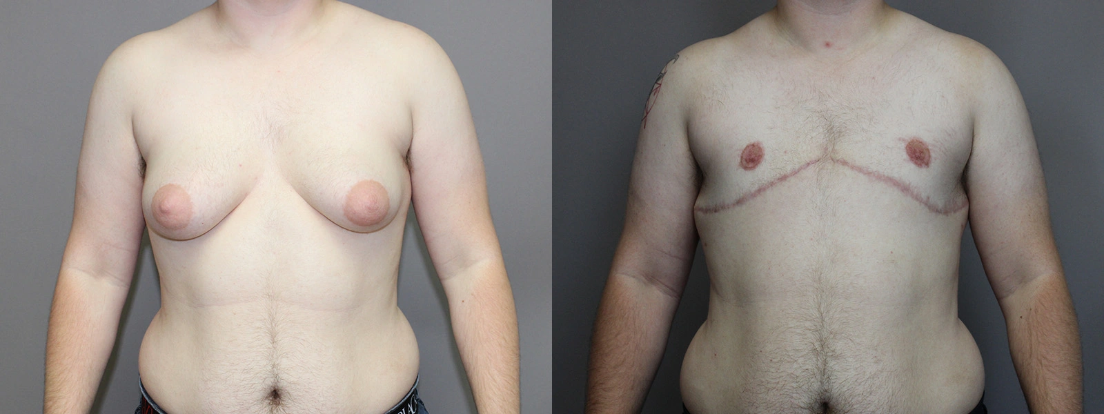 Before and After Plastic Surgery Results | CraftMD Scottsdale & Phoenix, AZ