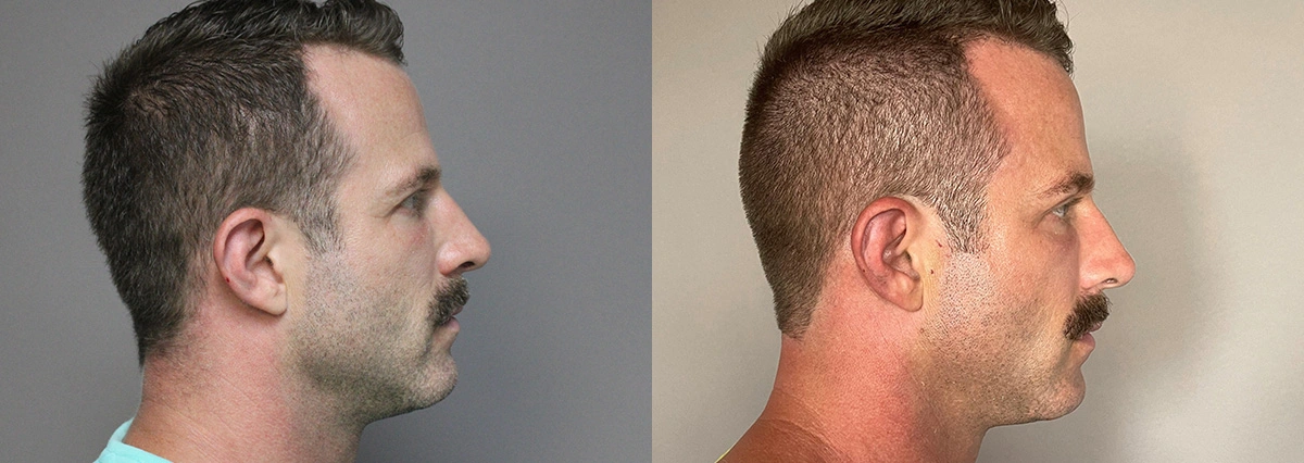 Before and After Plastic Surgery Results | CraftMD Scottsdale & Phoenix, AZ