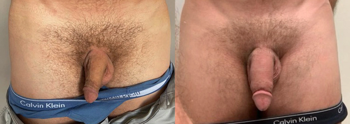 Before and After Plastic Surgery Results | CraftMD Scottsdale & Phoenix, AZ