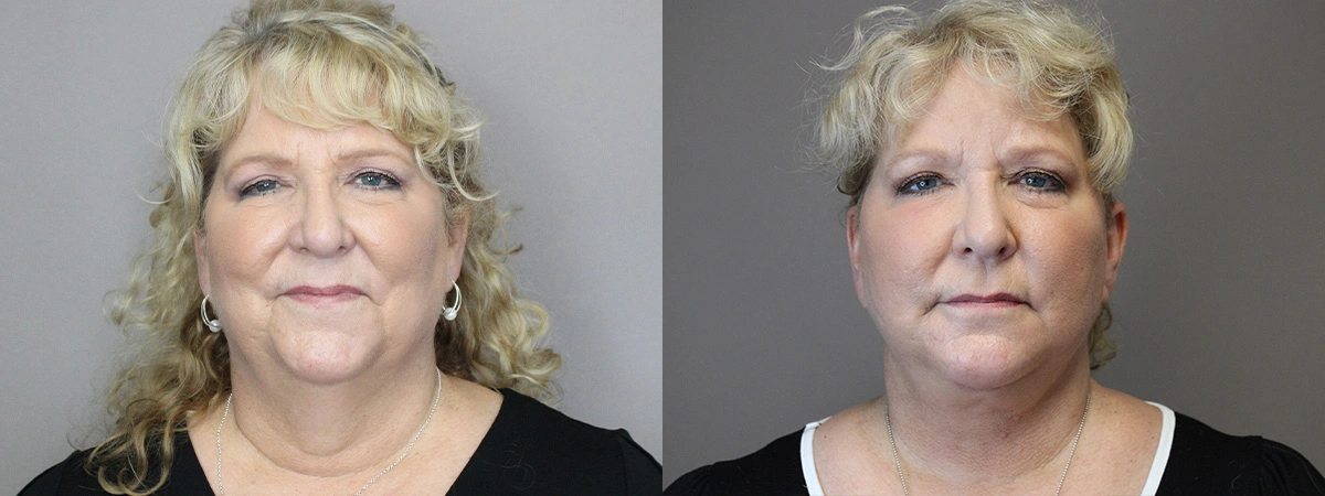 Before and After Plastic Surgery Results | CraftMD Scottsdale & Phoenix, AZ