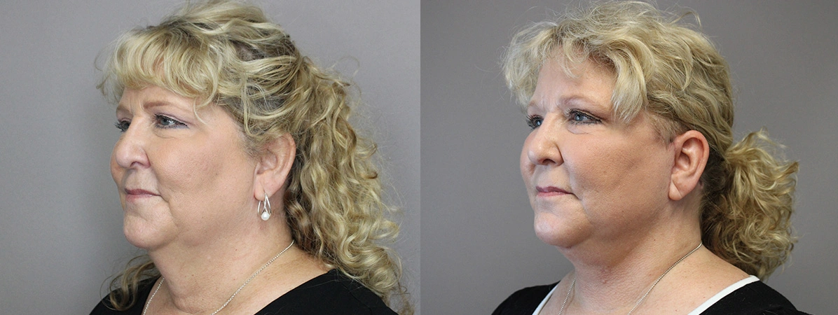 Before and After Plastic Surgery Results | CraftMD Scottsdale & Phoenix, AZ