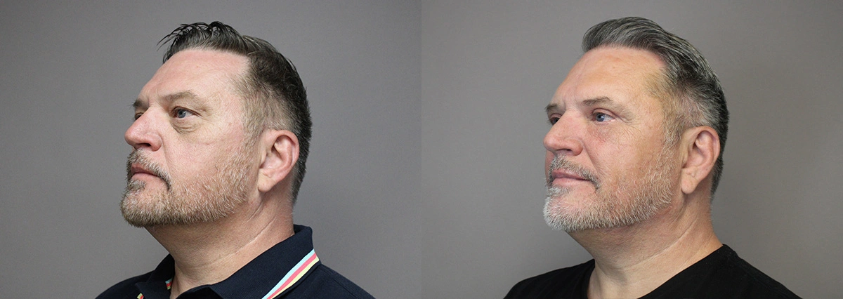 Before and After Plastic Surgery Results | CraftMD Scottsdale & Phoenix, AZ