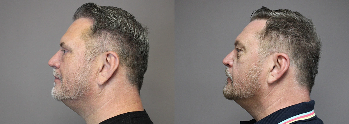 Before and After Plastic Surgery Results | CraftMD Scottsdale & Phoenix, AZ