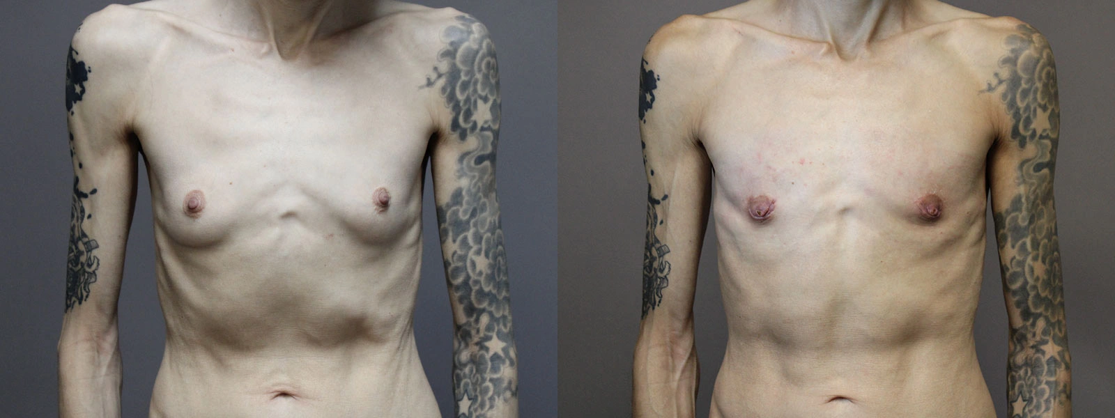 Before and After Plastic Surgery Results | CraftMD Scottsdale & Phoenix, AZ