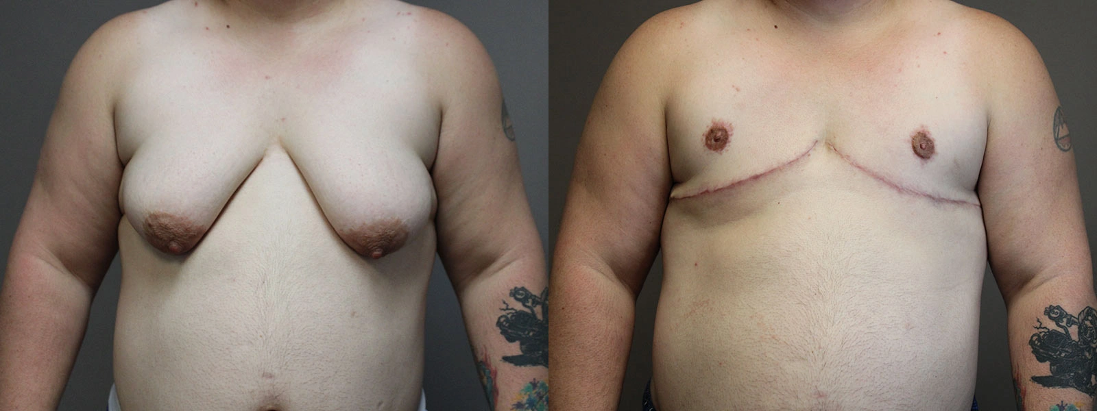 Before and After Plastic Surgery Results | CraftMD Scottsdale & Phoenix, AZ