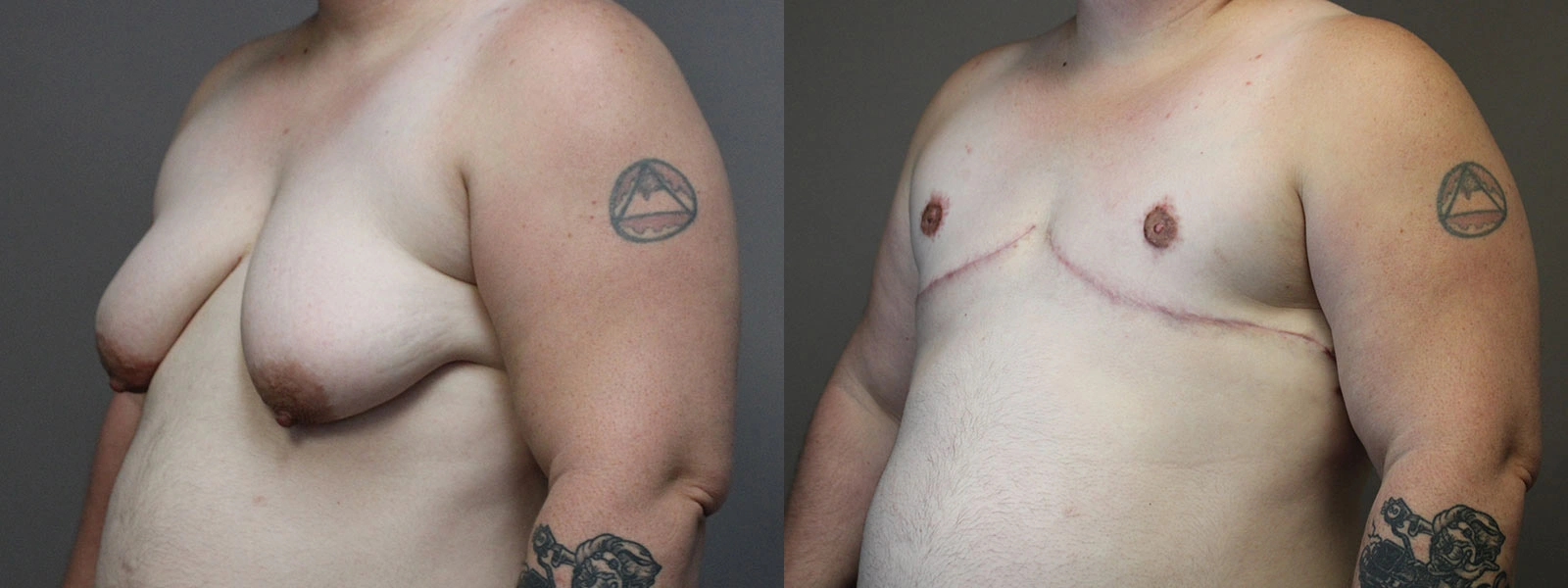 Before and After Plastic Surgery Results | CraftMD Scottsdale & Phoenix, AZ