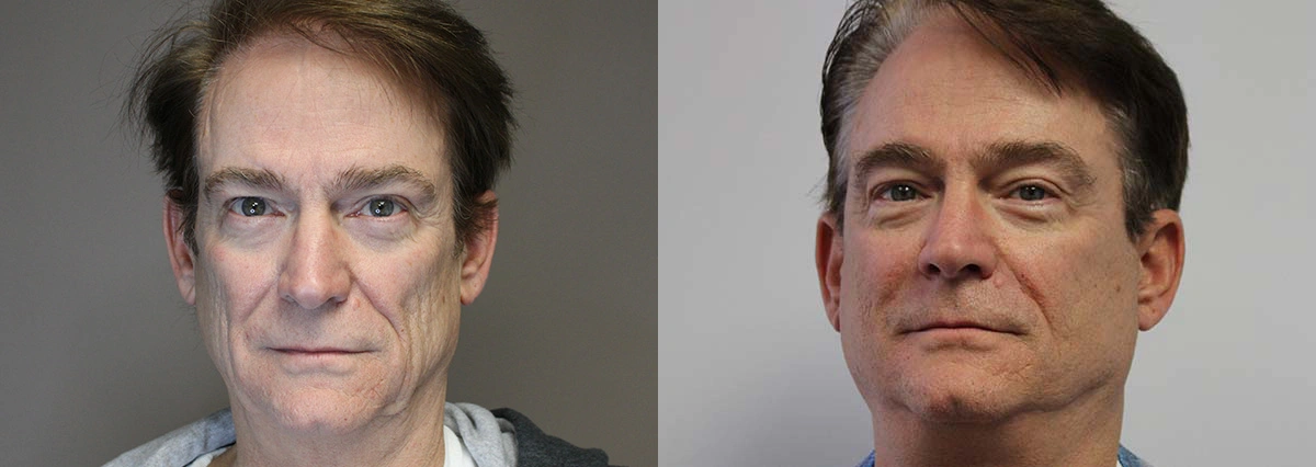 Before and After Plastic Surgery Results | CraftMD Scottsdale & Phoenix, AZ