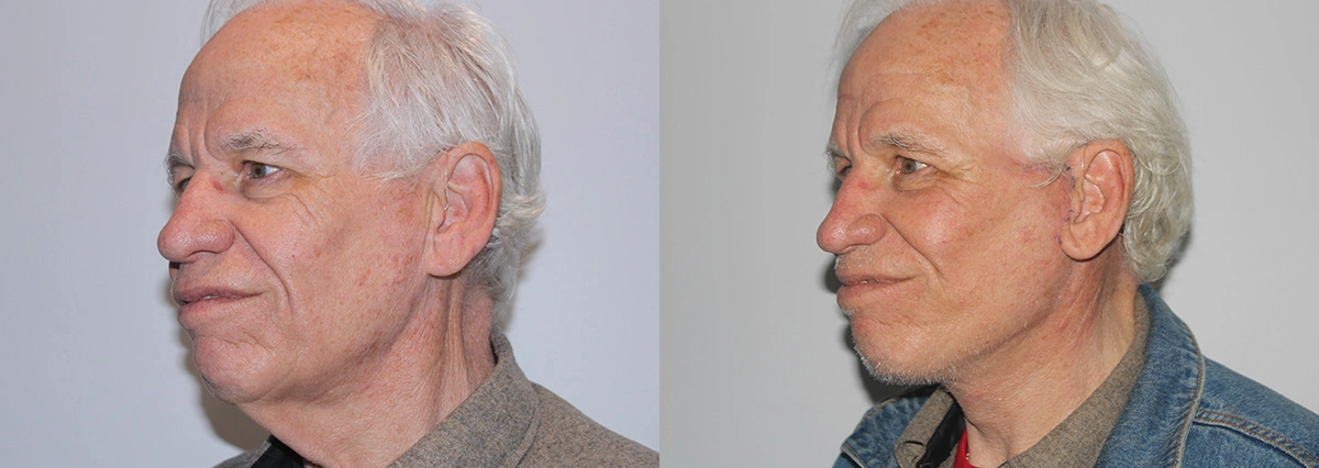 Before and After Plastic Surgery Results | CraftMD Scottsdale & Phoenix, AZ