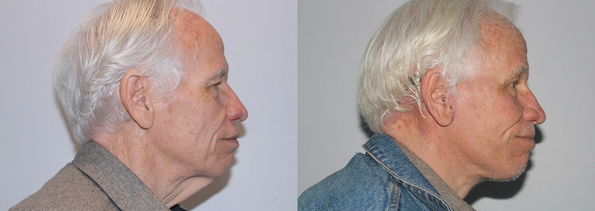 Before and After Plastic Surgery Results | CraftMD Scottsdale & Phoenix, AZ