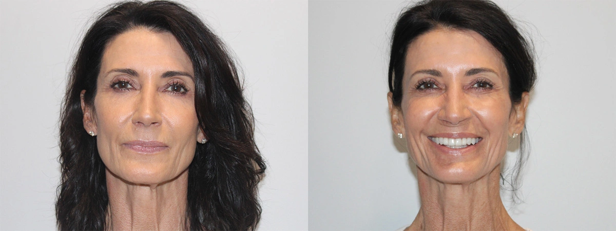Before and After Plastic Surgery Results | CraftMD Scottsdale & Phoenix, AZ