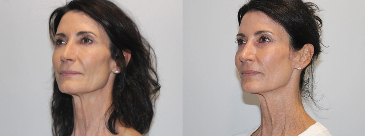 Before and After Plastic Surgery Results | CraftMD Scottsdale & Phoenix, AZ