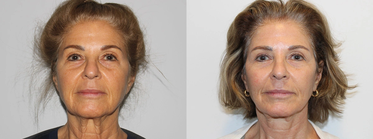Before and After Plastic Surgery Results | CraftMD Scottsdale & Phoenix, AZ