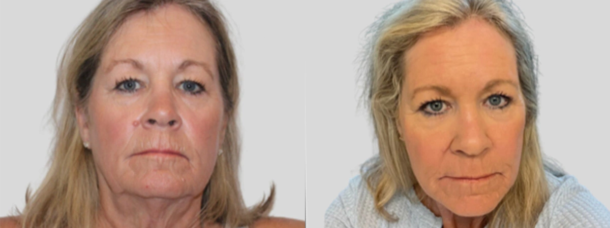 Before and After Plastic Surgery Results | CraftMD Scottsdale & Phoenix, AZ