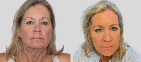 Before and After Plastic Surgery Results | CraftMD Scottsdale & Phoenix, AZ