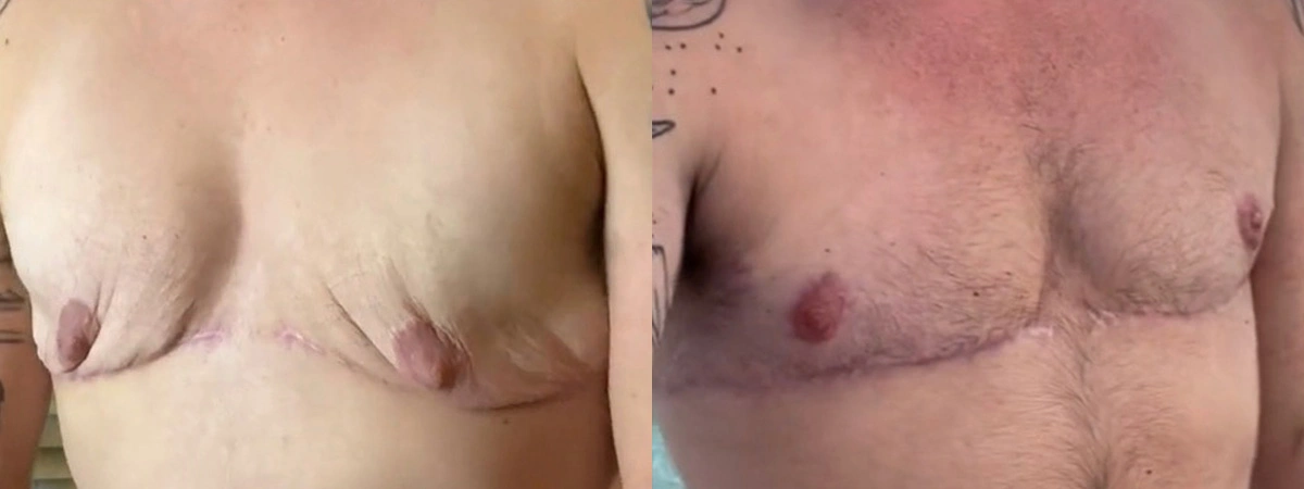 Before and After Plastic Surgery Results | CraftMD Scottsdale & Phoenix, AZ