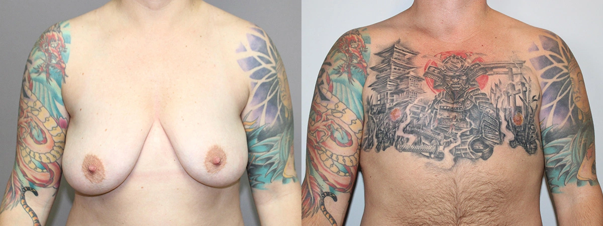 Before and After Plastic Surgery Results | CraftMD Scottsdale & Phoenix, AZ