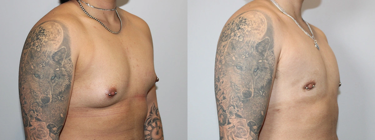 Before and After Plastic Surgery Results | CraftMD Scottsdale & Phoenix, AZ