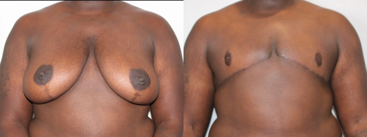 Before and After Plastic Surgery Results | CraftMD Scottsdale & Phoenix, AZ