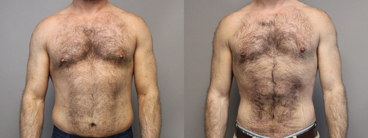 Before and After Plastic Surgery Results | CraftMD Scottsdale & Phoenix, AZ