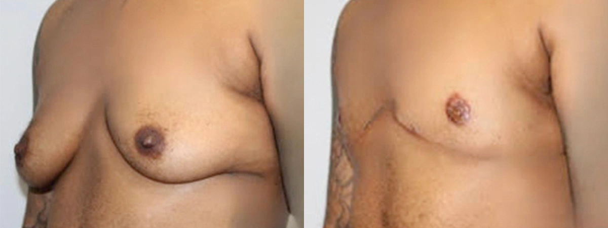 Before and After Plastic Surgery Results | CraftMD Scottsdale & Phoenix, AZ