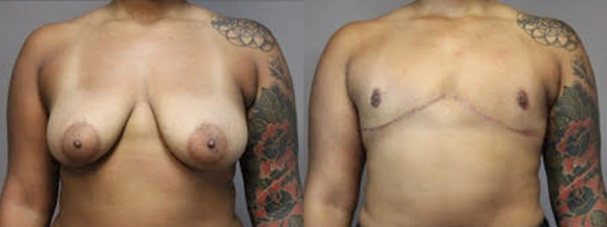 Before and After Plastic Surgery Results | CraftMD Scottsdale & Phoenix, AZ