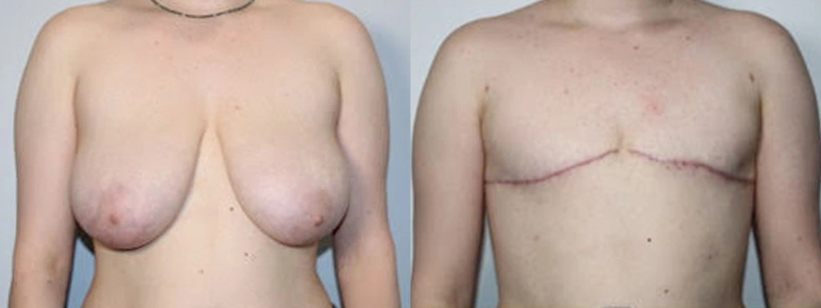Before and After Plastic Surgery Results | CraftMD Scottsdale & Phoenix, AZ