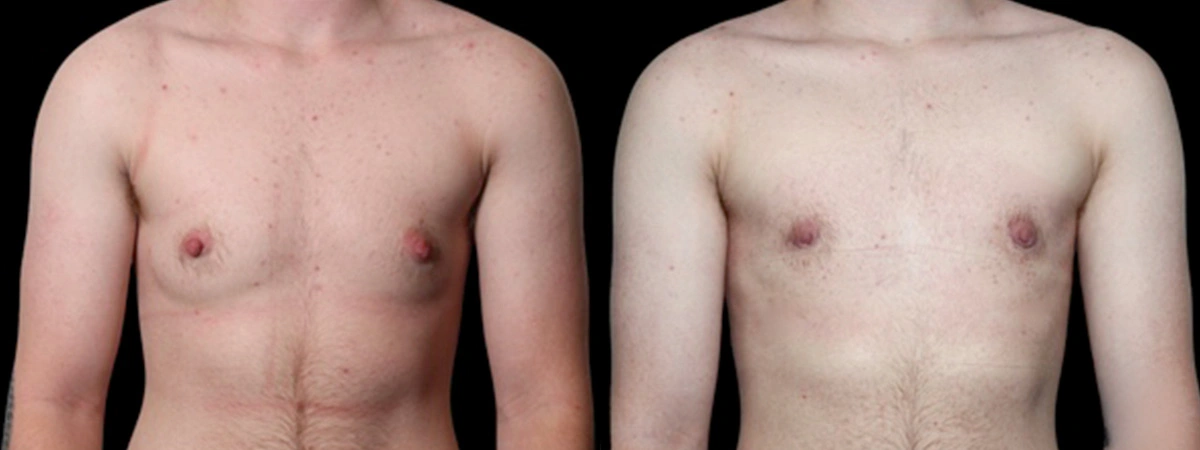 Before and After Plastic Surgery Results | CraftMD Scottsdale & Phoenix, AZ