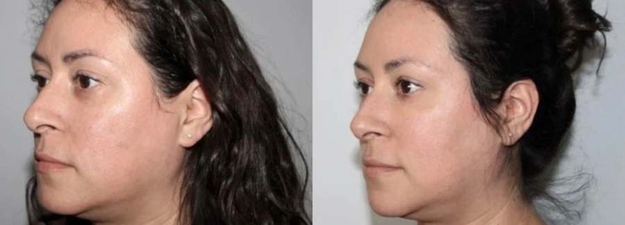 Before and After Plastic Surgery Results | CraftMD Scottsdale & Phoenix, AZ