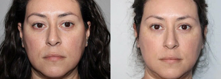 Before and After Plastic Surgery Results | CraftMD Scottsdale & Phoenix, AZ