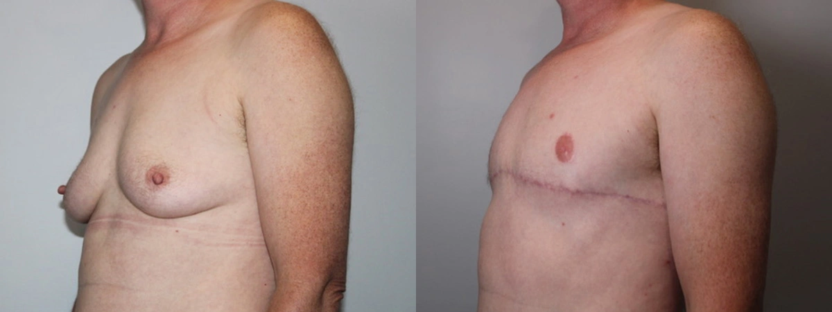Before and After Plastic Surgery Results | CraftMD Scottsdale & Phoenix, AZ