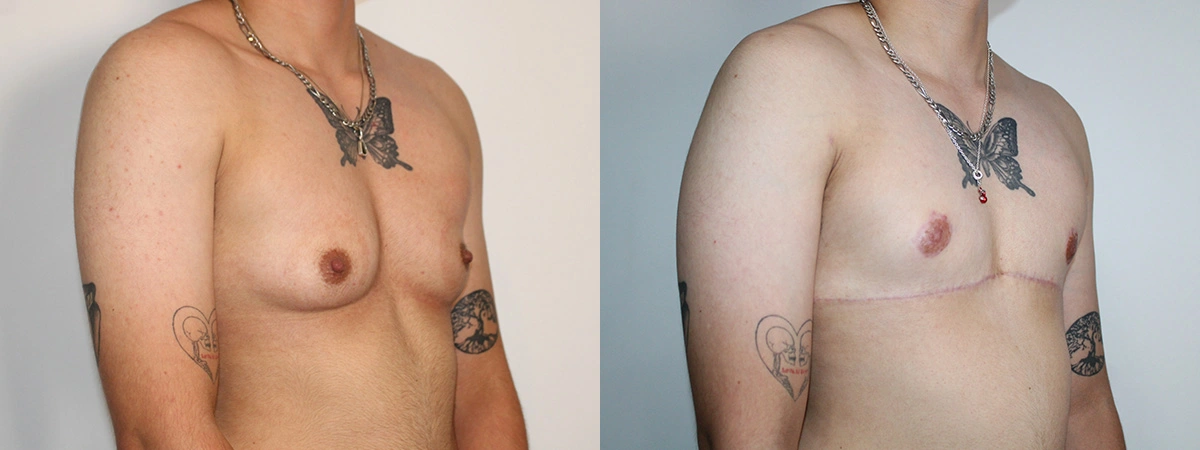 Before and After Plastic Surgery Results | CraftMD Scottsdale & Phoenix, AZ