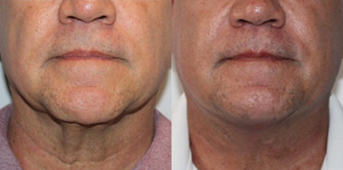 Before and After Plastic Surgery Results | CraftMD Scottsdale & Phoenix, AZ