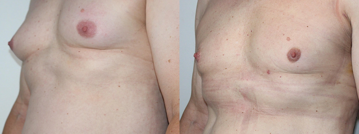 Before and After Plastic Surgery Results | CraftMD Scottsdale & Phoenix, AZ