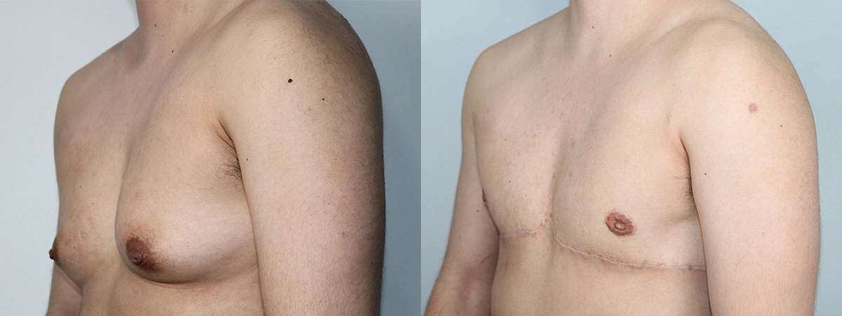 Before and After Plastic Surgery Results | CraftMD Scottsdale & Phoenix, AZ