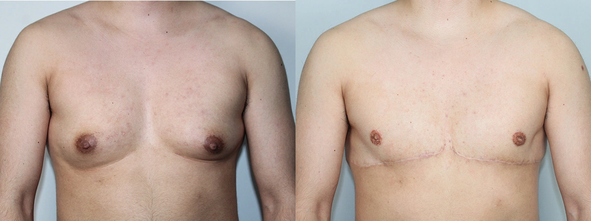 Before and After Plastic Surgery Results | CraftMD Scottsdale & Phoenix, AZ
