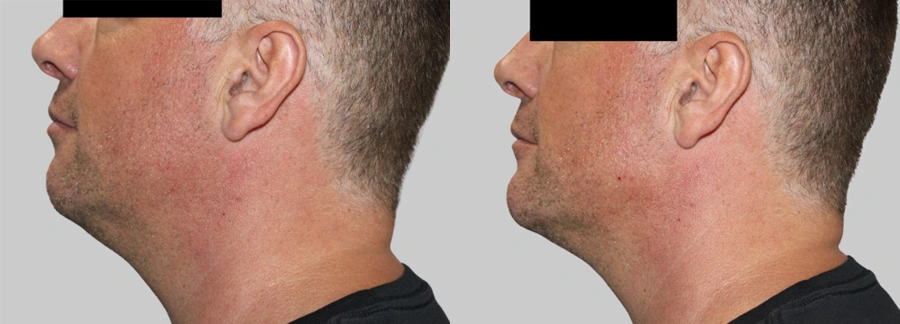 Before and After Plastic Surgery Results | CraftMD Scottsdale & Phoenix, AZ