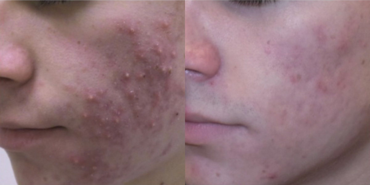 6258-acne-p01-1