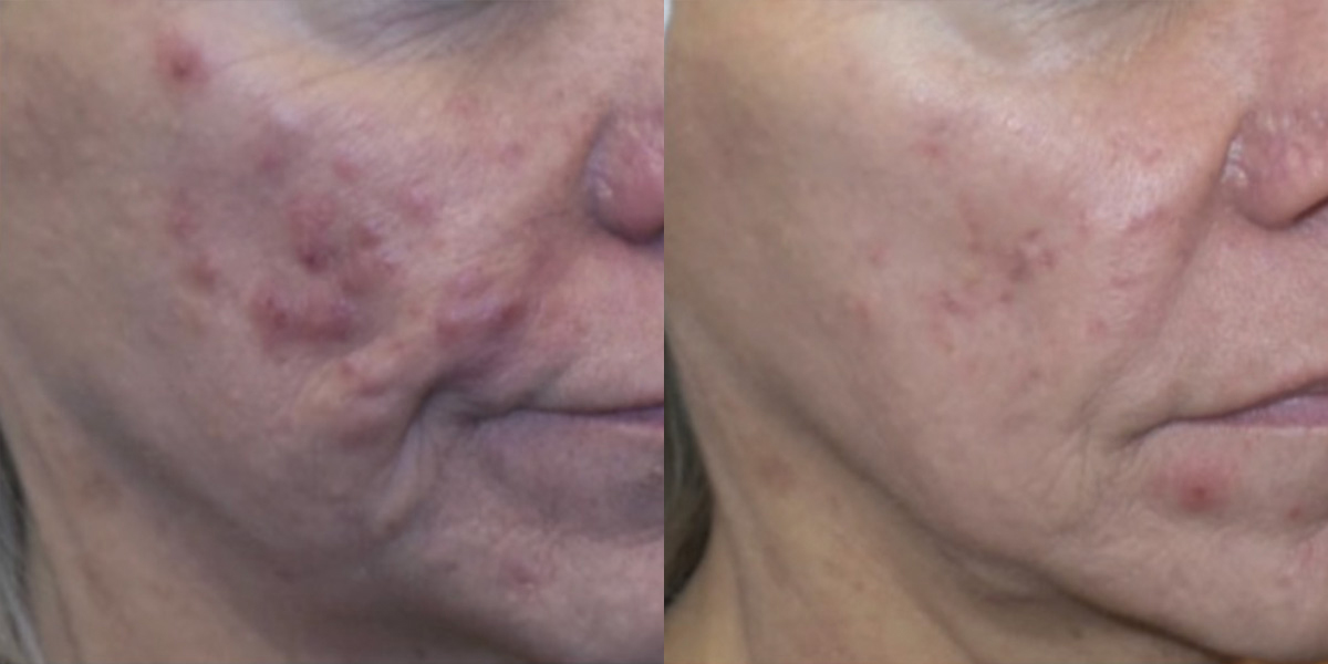 6259-acne-p02-1