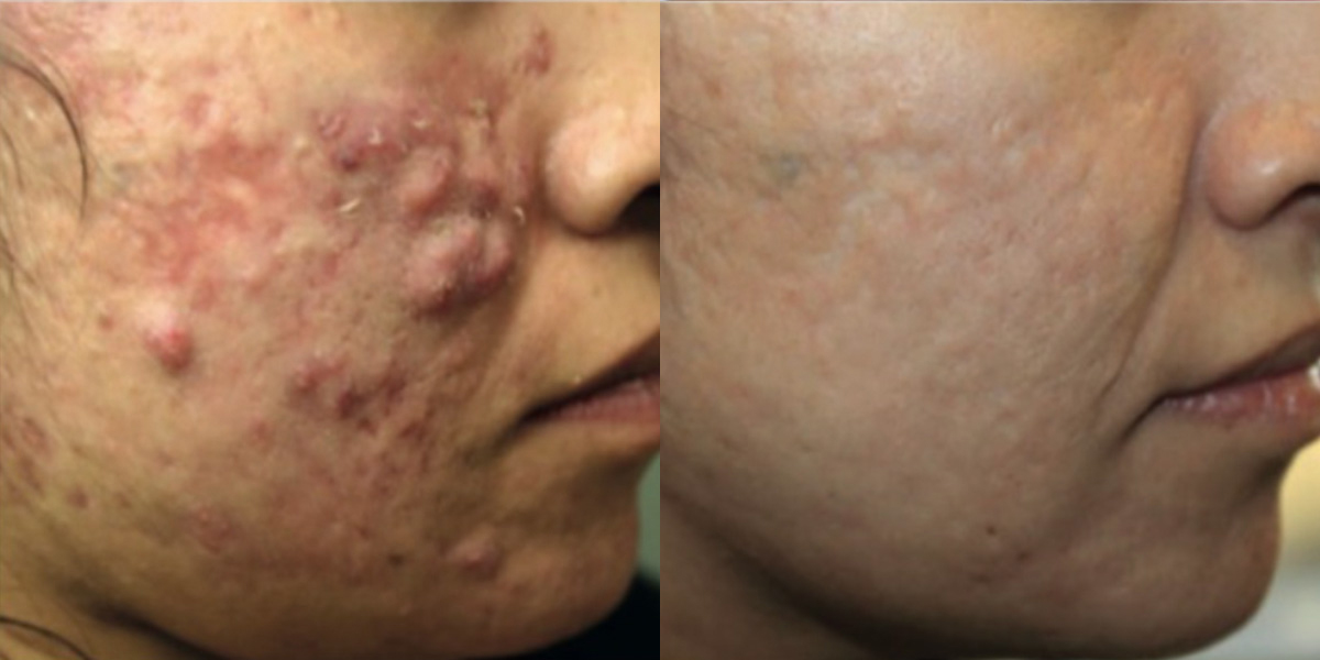 6261-acne-p03-1