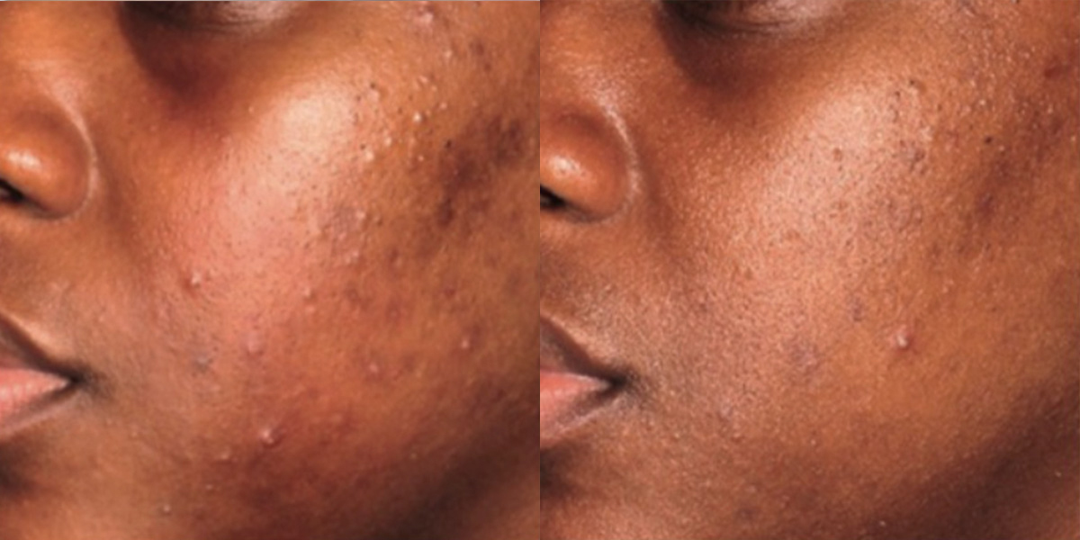 6263-acne-p04-1