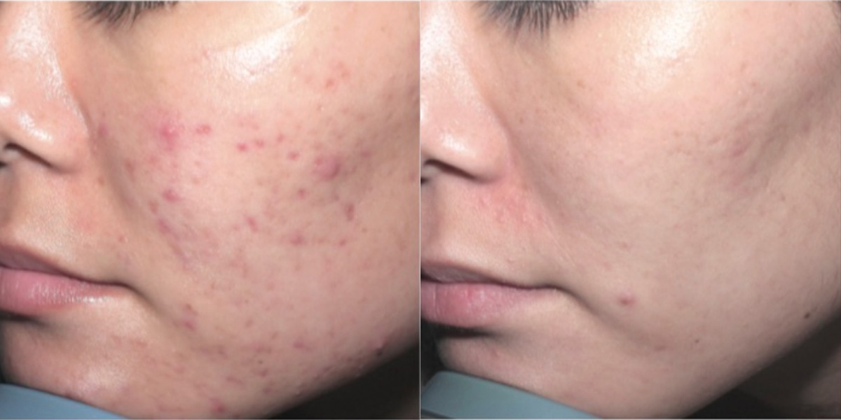 6267-acne-p06-1