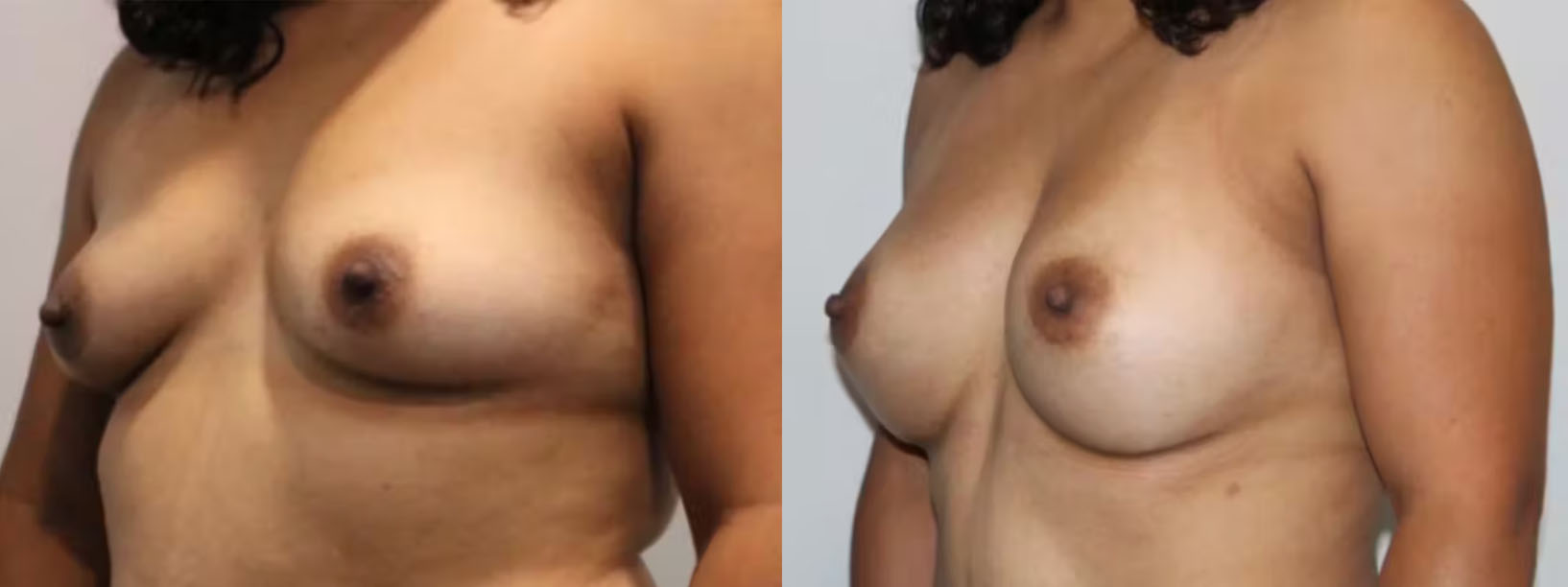 breast-augmentation-case-5
