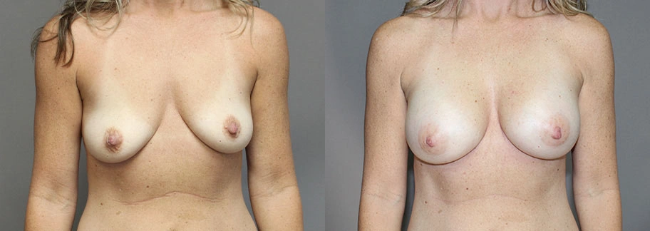 5859-breastaug-p01-1