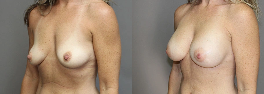 5860-breastaug-p01-2